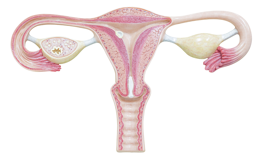 Imagen de mioma uterino